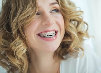 Braces for Adults Price: What You Need to Know Braces