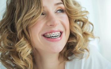 Braces for Adults Price: What You Need to Know Braces
