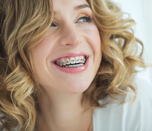 Braces for Adults Price: What You Need to Know Braces