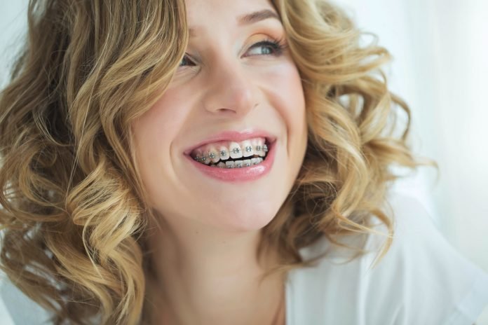 Braces for Adults Price: What You Need to Know