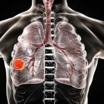 5 Ways To Prevent Lung Cancer