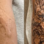 Tattoo Over Scars Before n' Afta - Yo ass Need ta Know