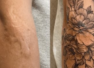 Tattoo Over Scars Before and After – Everything You Need to Know Tattoo Over Scars Before and After - You Need to Know
