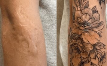 Tattoo Over Scars Before and After – Everything You Need to Know Tattoo Over Scars Before and After - You Need to Know