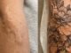 Tattoo Over Scars Before and After – Everything You Need to Know Tattoo Over Scars Before and After - You Need to Know