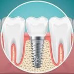 What Are the Different Types of Dental Implants That Exist Today?