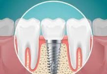 What Are the Different Types of Dental Implants That Exist Today? What Are the Different Types of Dental Implants That Exist Today?
