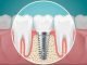 What Are the Different Types of Dental Implants That Exist Today? What Are the Different Types of Dental Implants That Exist Today?