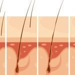 The Journey to Beautiful Hair: Unlocking Youthfulness with Veraclinic Preventing Hair Fall through Hair Transplant: What Does 1 Graft of Hair Cost?