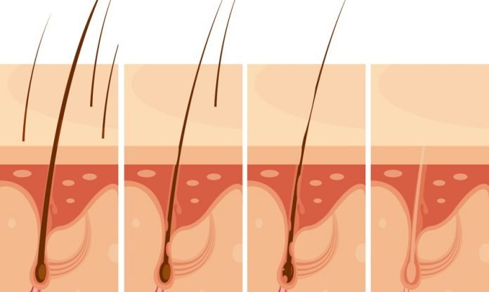 Preventing Hair Fall through Hair Transplant: What Does 1 Graft of Hair Cost?