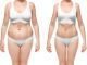 The Pros Of Liposuction Liposuction