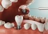 5 Common Alternatives to Dental Implants Dental Implants