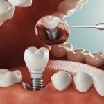 5 Common Alternatives to Dental Implants Dental Implants