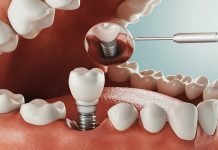 5 Common Alternatives to Dental Implants Dental Implants