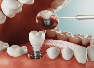 5 Common Alternatives to Dental Implants Dental Implants
