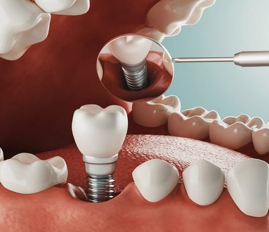 5 Common Alternatives to Dental Implants Dental Implants