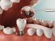 5 Common Alternatives to Dental Implants Dental Implants