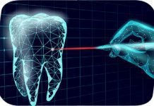 Everything You Need to Know About Laser Implant Dentistry Laser Implant Dentistry