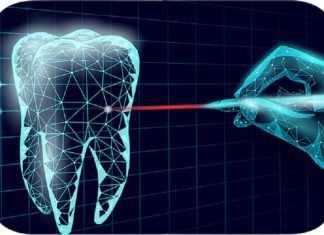 Everything You Need to Know About Laser Implant Dentistry Laser Implant Dentistry