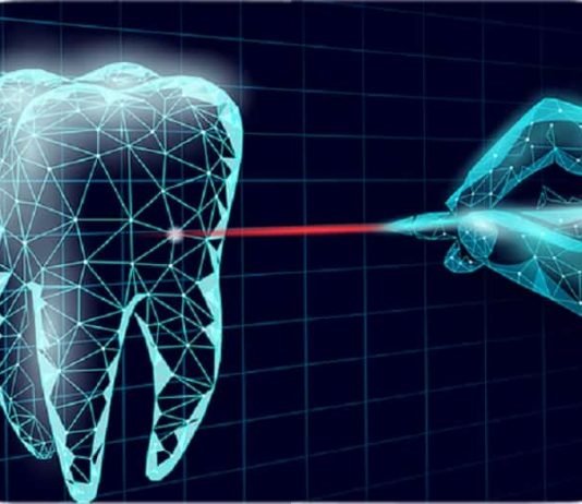 Everything You Need to Know About Laser Implant Dentistry Laser Implant Dentistry