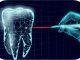 Everything You Need to Know About Laser Implant Dentistry Laser Implant Dentistry