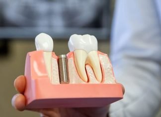 Top Benefits of Choosing a Denture Repair Over Denture Replacements Denture Repair
