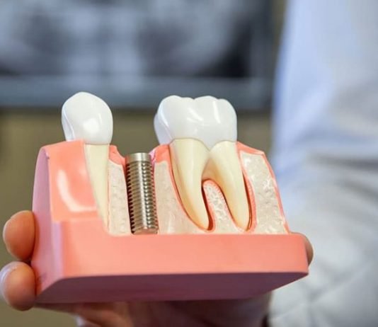 Top Benefits of Choosing a Denture Repair Over Denture Replacements Denture Repair