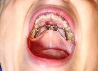 Align and Straighten Your Teeth for a Better-Looking You Teeth