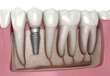 Dental Implant Solutions for Modern Smiles Dental Implant