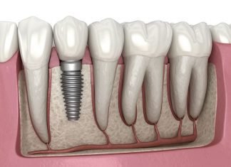 Dental Implant Solutions for Modern Smiles Dental Implant