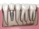 Dental Implant Solutions for Modern Smiles Dental Implant