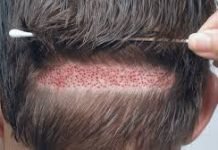 Which hair transplant method is the best: FUE or FUT? FUE or FUT