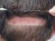 Which hair transplant method is the best: FUE or FUT? FUE or FUT