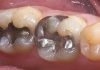 Removing Old Amalgam Fillings Safely and Pain-Free — How, When, Why. Amalgam