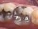 Removing Old Amalgam Fillings Safely and Pain-Free — How, When, Why. Amalgam