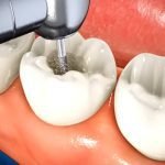 What Happens During a Root Canal Procedure? What Happens During a Root Canal Procedure?