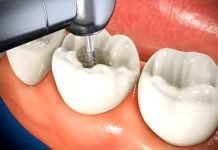 What Happens During a Root Canal Procedure? What Happens During a Root Canal Procedure?