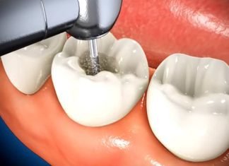 What Happens During a Root Canal Procedure? What Happens During a Root Canal Procedure?