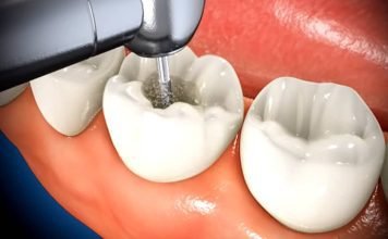 What Happens During a Root Canal Procedure? What Happens During a Root Canal Procedure?