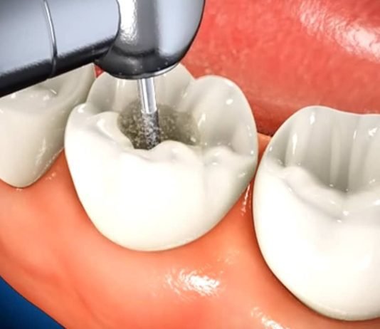 What Happens During a Root Canal Procedure? What Happens During a Root Canal Procedure?
