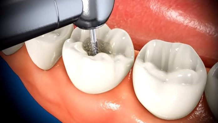 What Happens During a Root Canal Procedure?