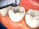 What Happens During a Root Canal Procedure? What Happens During a Root Canal Procedure?
