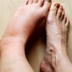 Postoperative Swelling