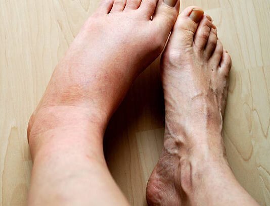 What is property flipping and how can you avoid making a loss? Postoperative Swelling