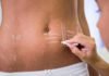 Postoperative Swelling: Ways for a Smoother Recovery After Abdominoplasty Postoperative Swelling