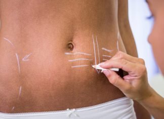 Postoperative Swelling: Ways for a Smoother Recovery After Abdominoplasty Postoperative Swelling