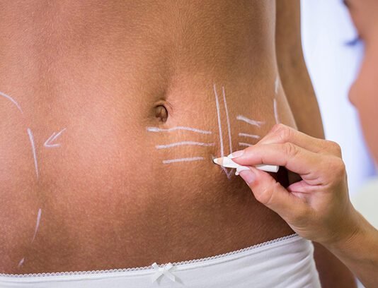 Postoperative Swelling: Ways for a Smoother Recovery After Abdominoplasty Postoperative Swelling