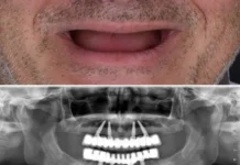 Affordable All-on-4 Dental Implants in Brisbane: Your Comprehensive Guide Dental Implants