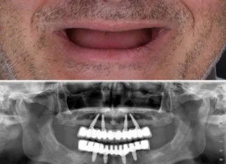 Affordable All-on-4 Dental Implants in Brisbane: Your Comprehensive Guide Dental Implants