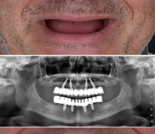 Affordable All-on-4 Dental Implants in Brisbane: Your Comprehensive Guide Dental Implants